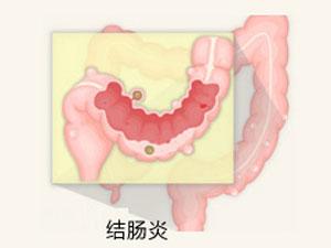 福州结肠炎怎么治疗好?