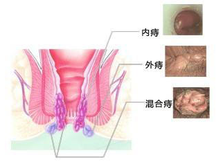 福州混合痔专业治疗办法?