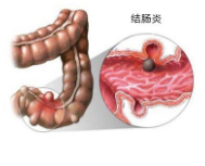 福州专业结肠炎专科医院