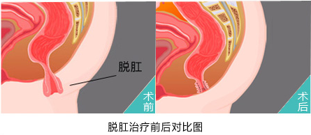 在福州哪家医院治疗脱肛不错?